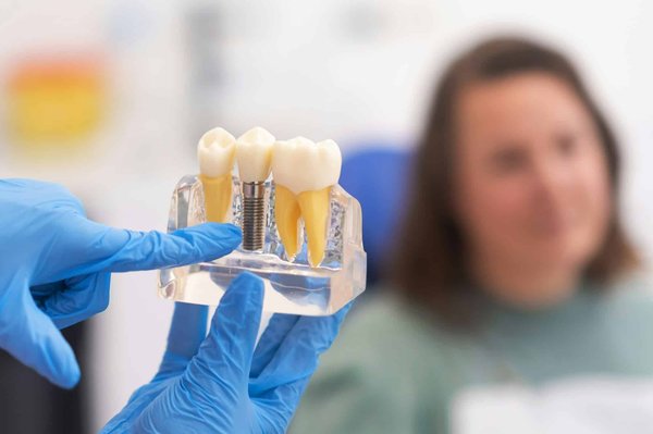 Comment traiter les dents manquantes avec des implants dentaires chez les dentistes locaux ?